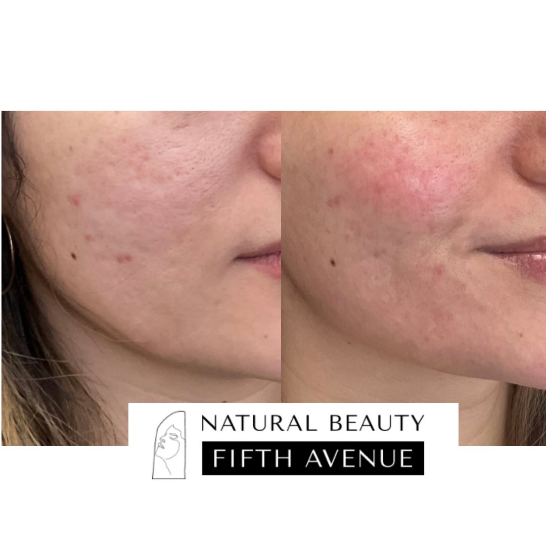 Before and after microneedling treatment showing improved skin texture and reduced acne scars on patient's cheek